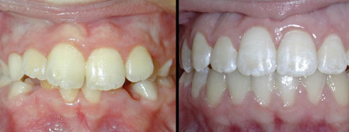 fully banded braces