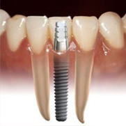dental implant clovis