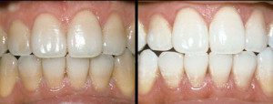 Whitening Before and After