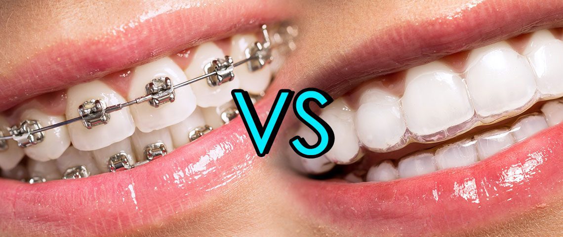 closeup of 2 mouths, one with metal braces, one with clear Invisalign