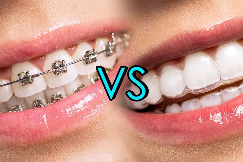 closeup of 2 mouths, one with metal braces, one with clear Invisalign