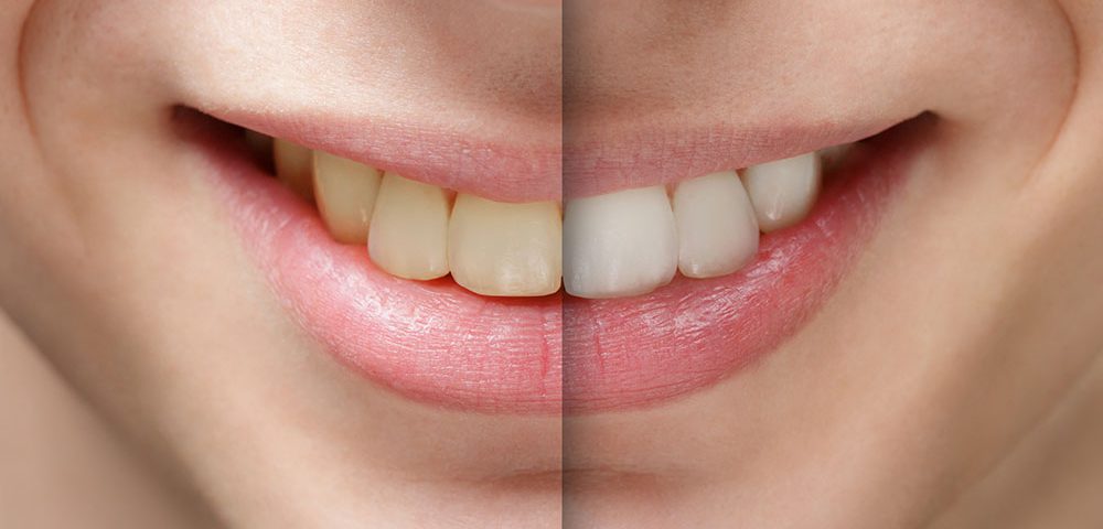 How to Whiten Your Teeth Safely