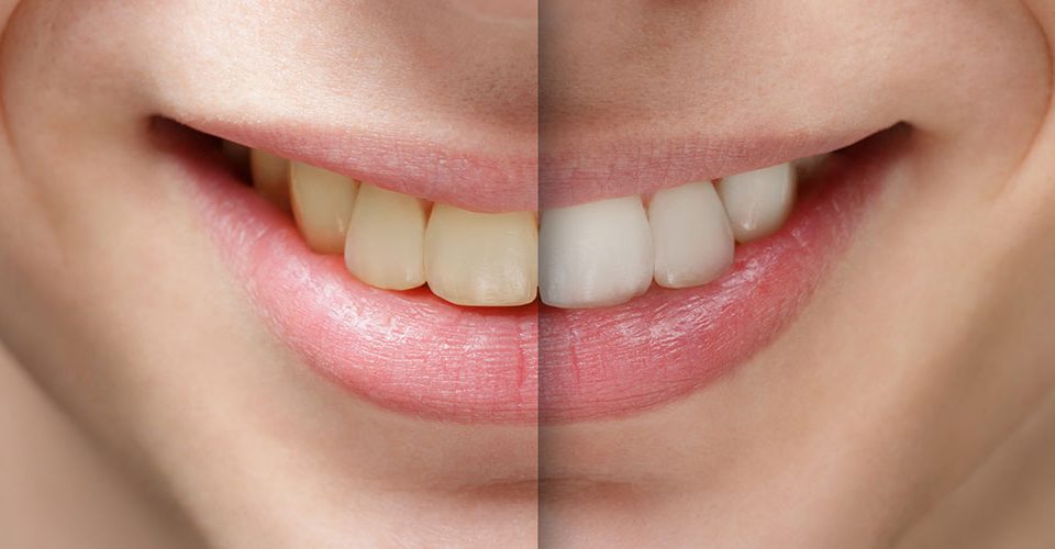 How to Whiten Your Teeth Safely