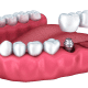 How Much Does it Usually Cost for Dental Implants