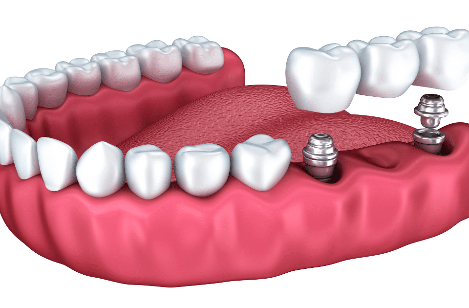 How Much Does it Usually Cost for Dental Implants