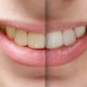 Is Teeth Whitening Bad for Your Teeth