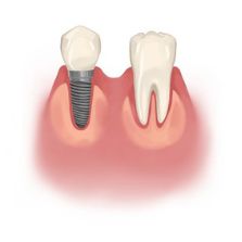 Is it better to get a bridge or an implant?