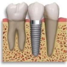 Can dental implants be done in a day?