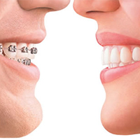 how much do braces cost - two people in profile, one with braces on left, without braces on right