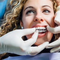 Can anyone get Invisalign? woman getting Invisalign placed on teeth