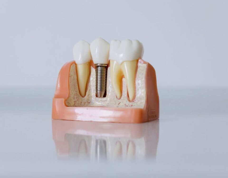 Dental implant model showing a titanium post placed in the jawbone