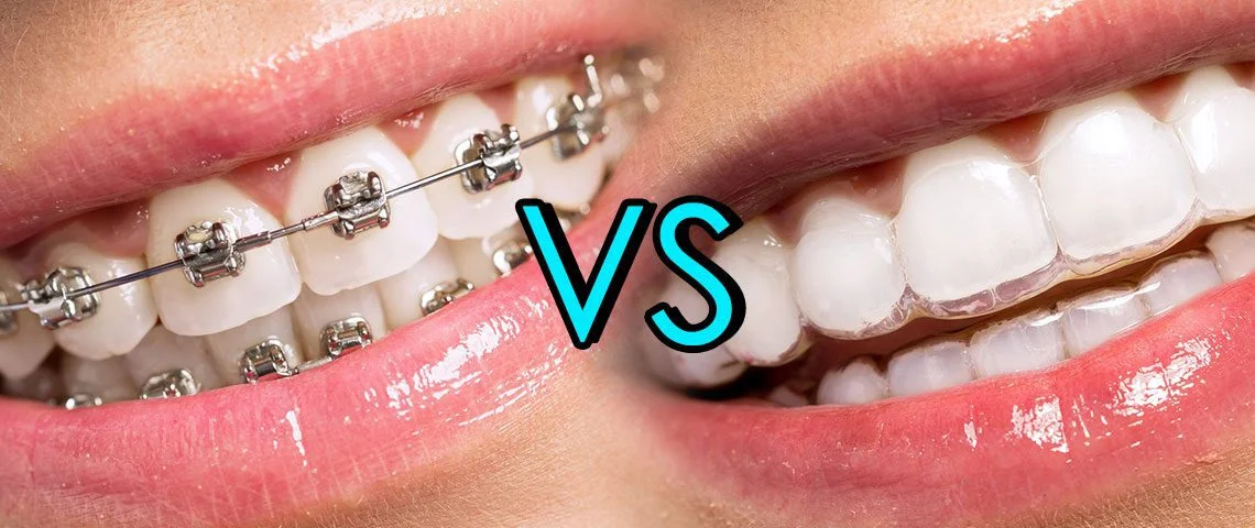 closeup of 2 mouths, one with metal braces, one with clear Invisalign