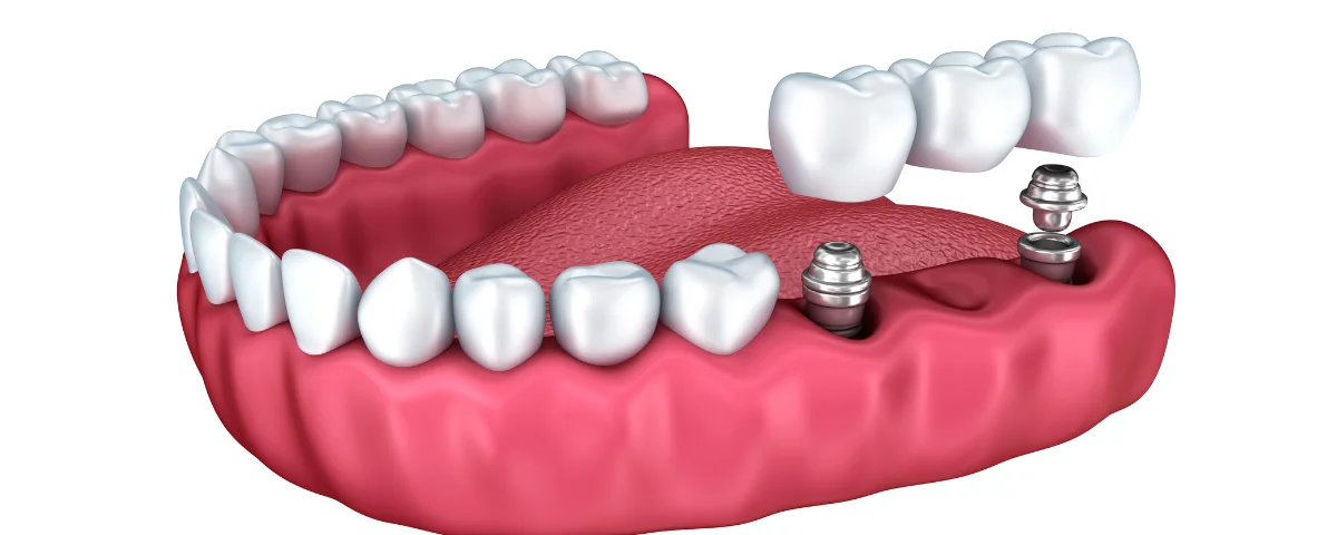 what are dental implants