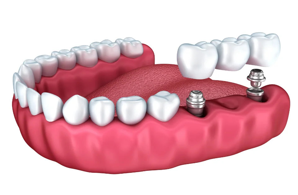 what are dental implants
